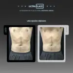 Aparelho De Ultrassom Digital Ultra Place Com 4 Aplicadores G e 2 Aplicadores M - Medical San